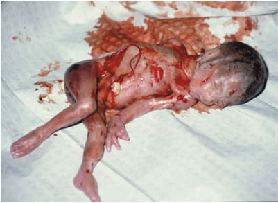 Aborto por succión